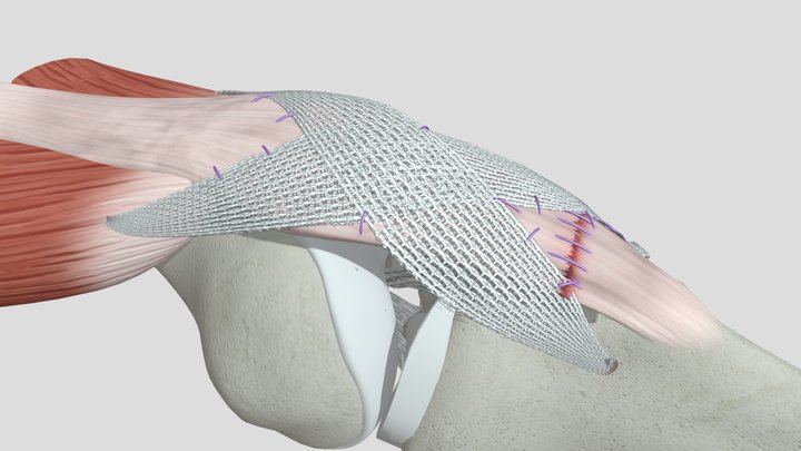 PatellarTape System™ 3D Model