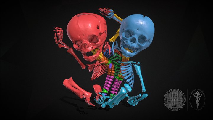Osteology of Parapagus Conjoined Twins 3D Model