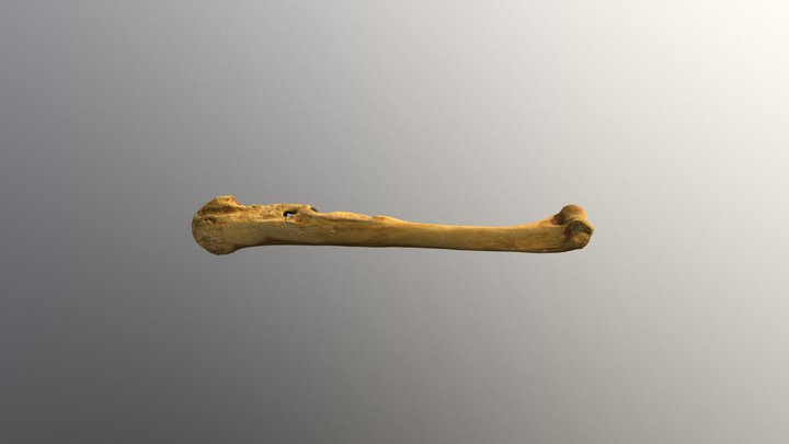 Osteomyelitis - Right Humerus 3D Model