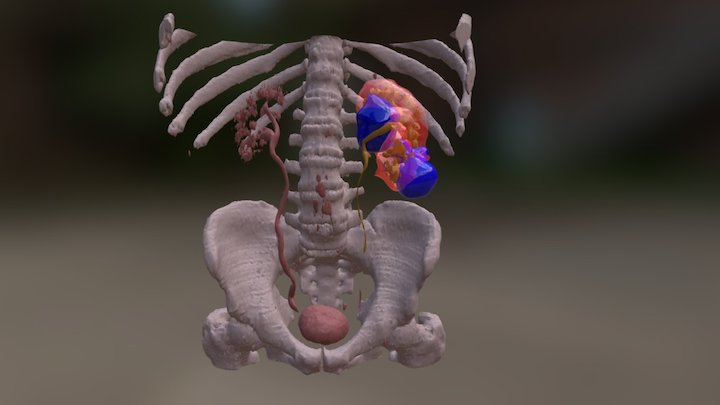 Urotac: poliquistosis renal izquierda 3D Model