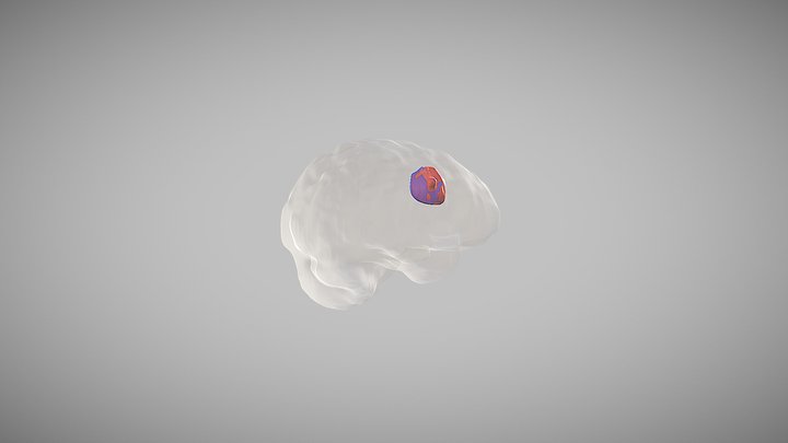 Tumors Project 3D Model