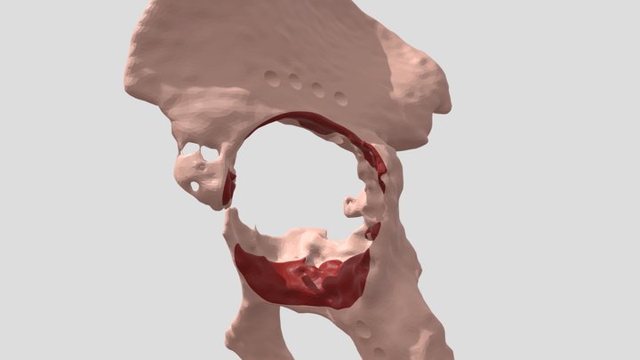 Prótesis de cadera paciente NL 3D Model