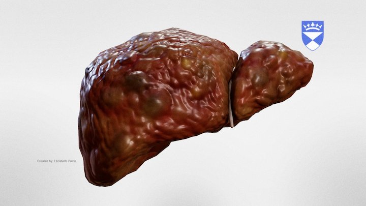 Cirrhotic Liver 3D Model
