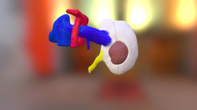Nierentumor Color Gesamt 3D Model
