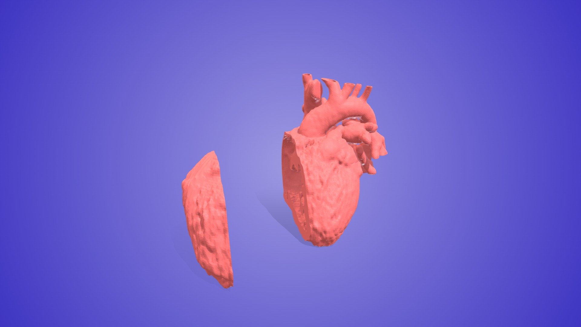 Tetralogy of Fallot