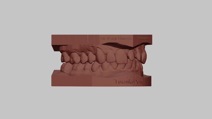 Dental model for 3D print