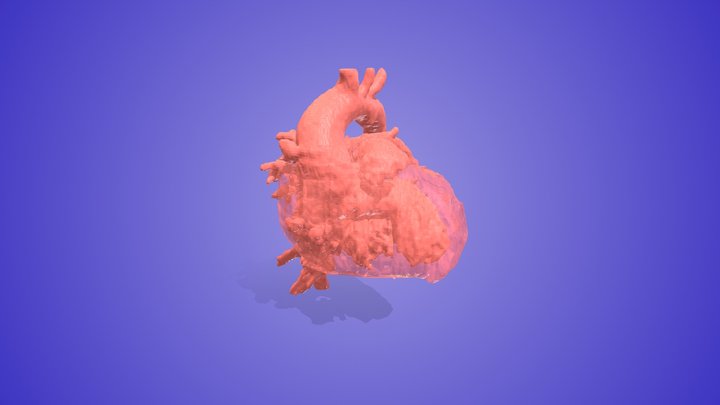 Pulmonary Atresia with Intact Ventricular Septum 3D Model
