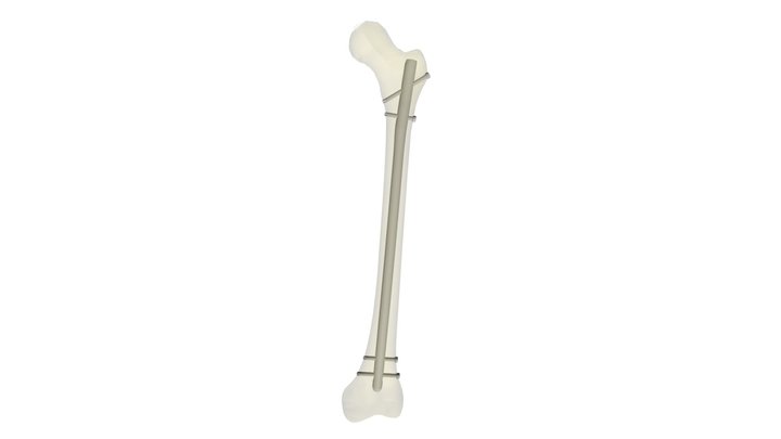 OIC Trochanteric Femur Nail 3D Model