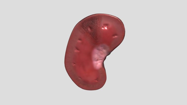 Renal Infarcts (Veterinary Pathology) 3D Model