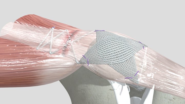 QuadsTape System™ 3D Model
