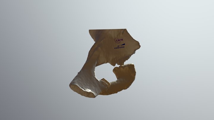 Pelvic Fracture 3D Model