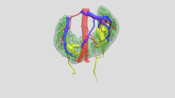 horseshoe kidney with stone 3D Model