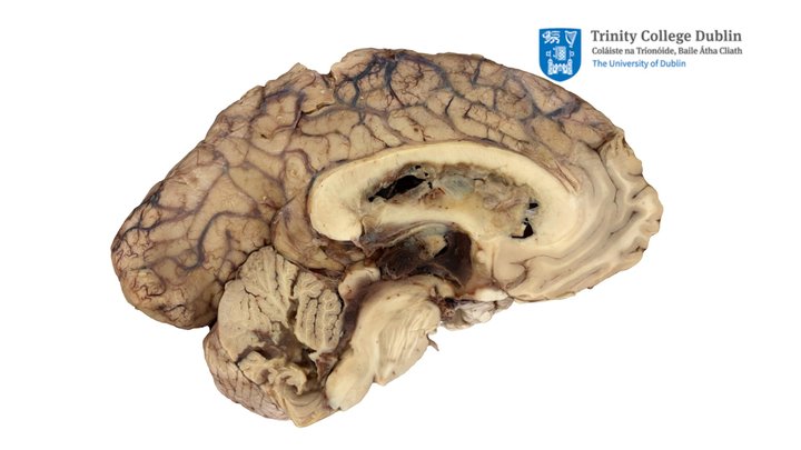 Intracranial Haemorrhage (Mid-Sagittal LH) 3D Model