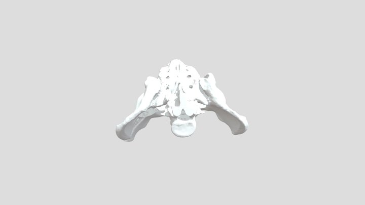 中國附醫-黃郁芳_-Pelvis_Pre-OP 3D Model