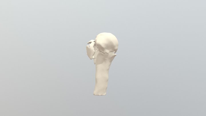 3-Part Fracture 3D Model