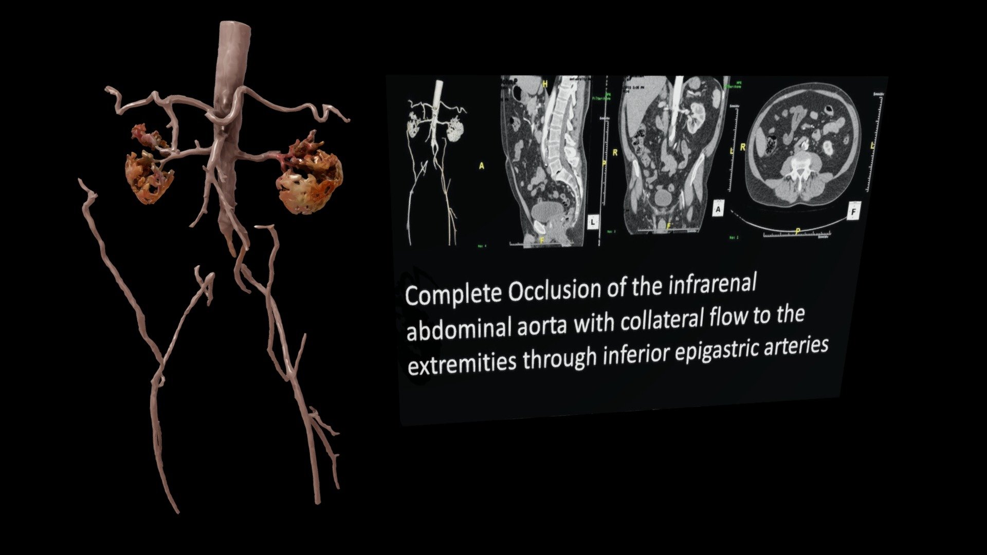 Occlusion of the Infrarenal Abdominal Aorta Download Free 3D model by