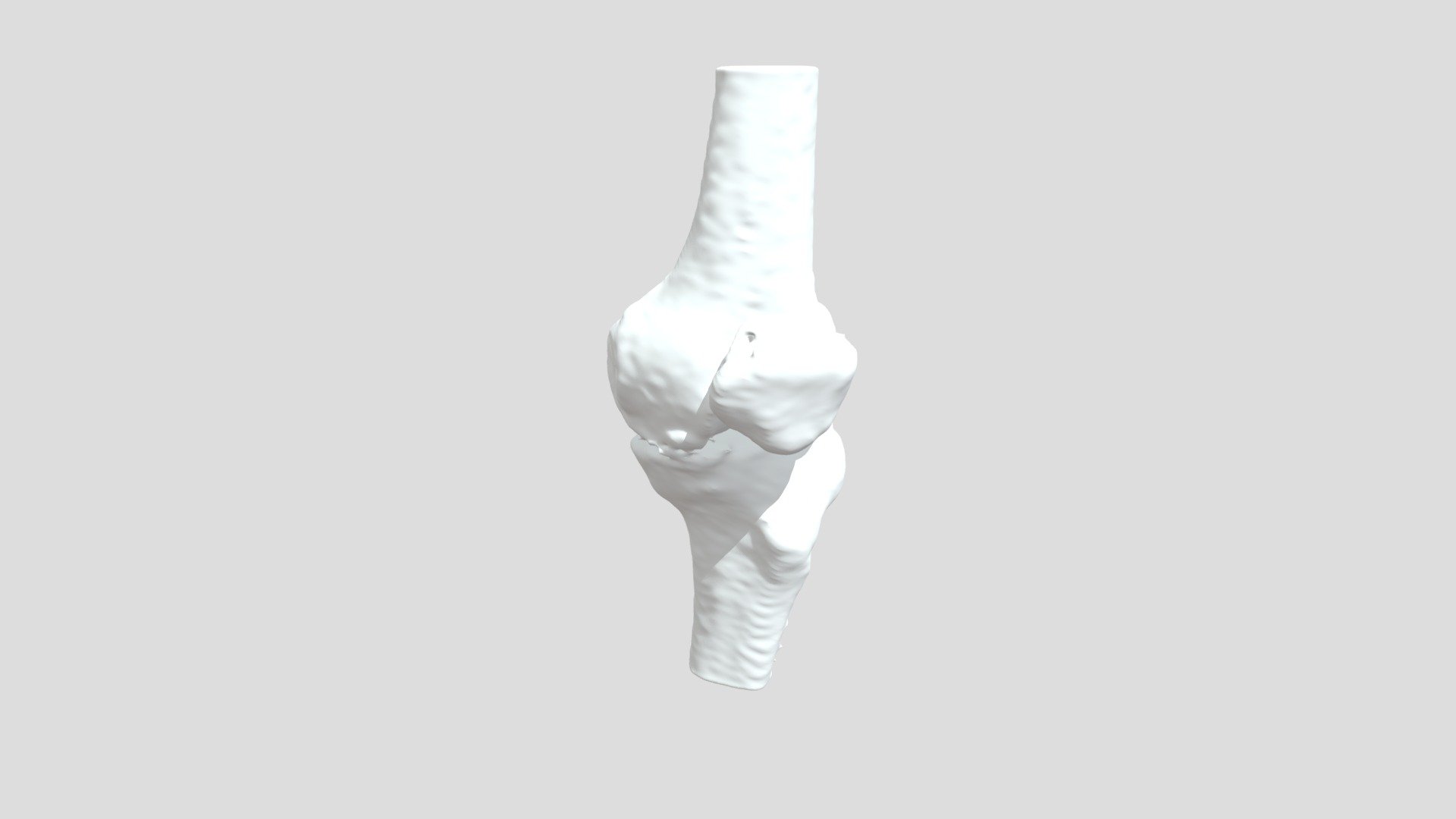 Segmentation Segment Trbn Lt Bone