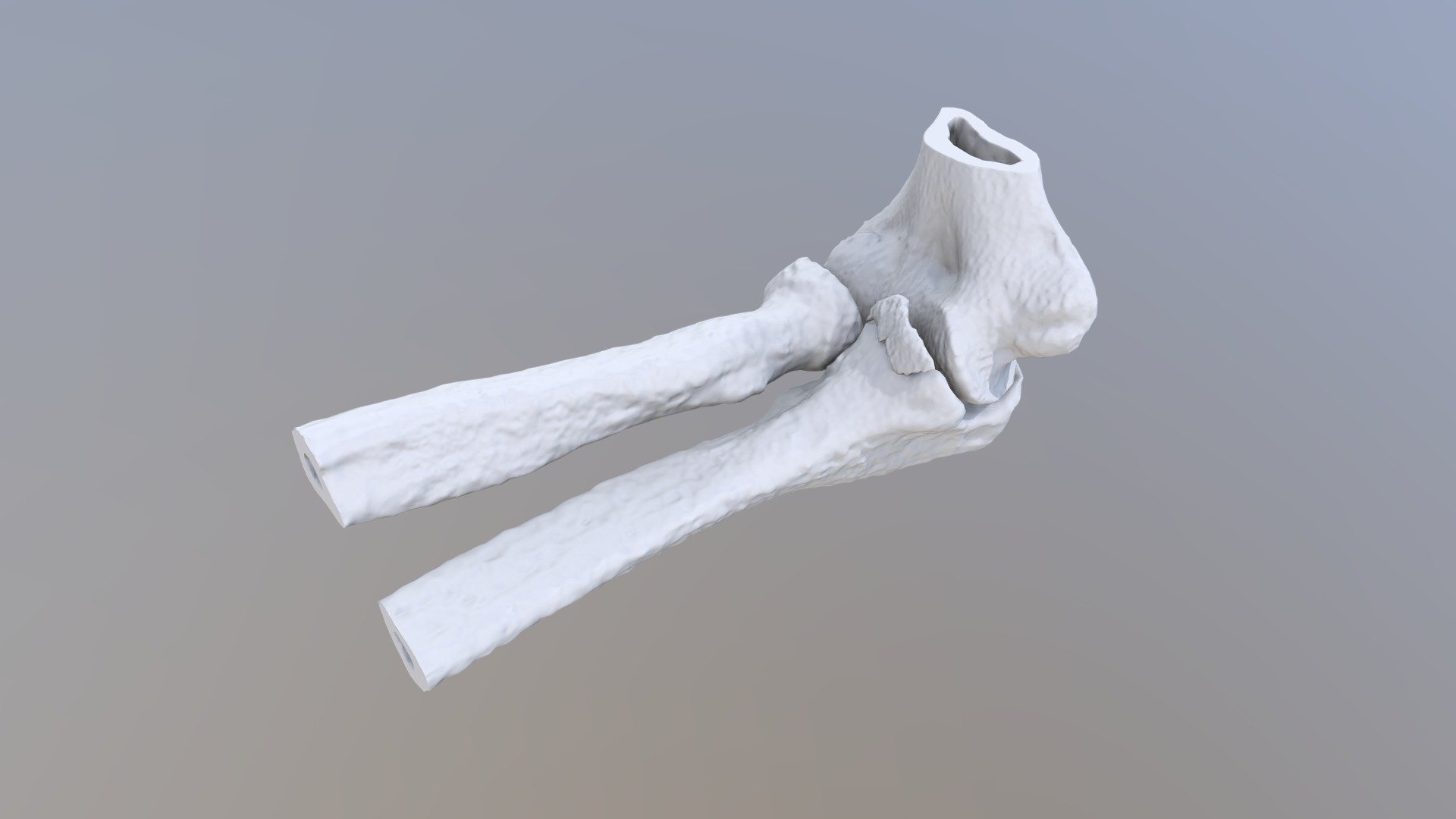 Fracture Of The Coronoid Process Of The Ulna 3d Model By Innowise