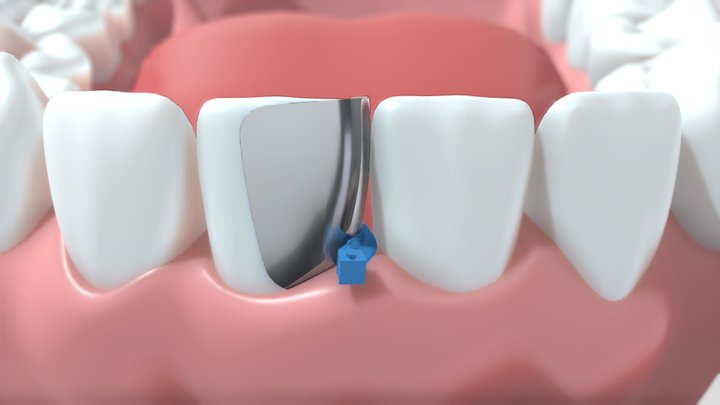 Anterior360 3D Model