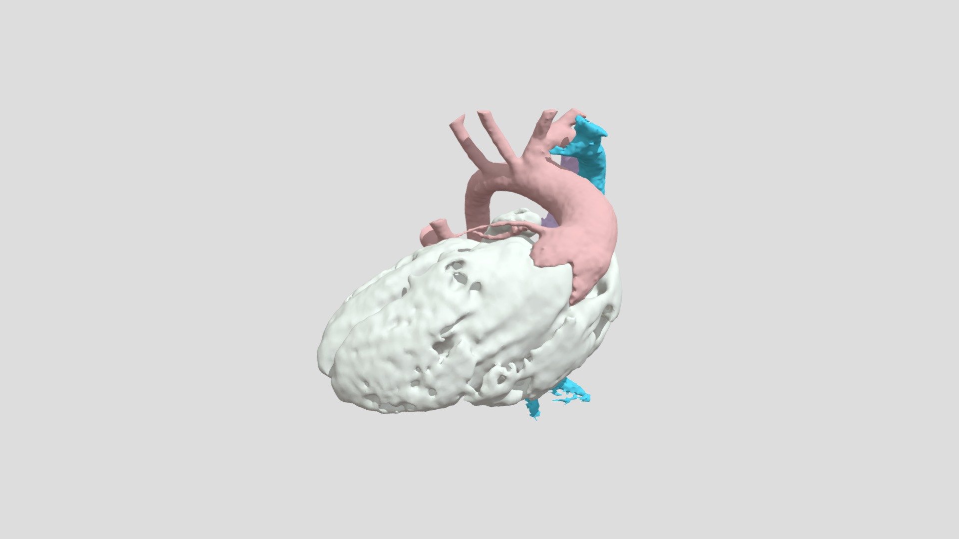 Heterotaxy, Dextrocardia, DORV, TAPVR (S0410) - 3D model by NCH ...