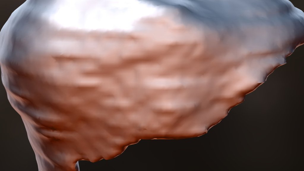 Liver HV PV