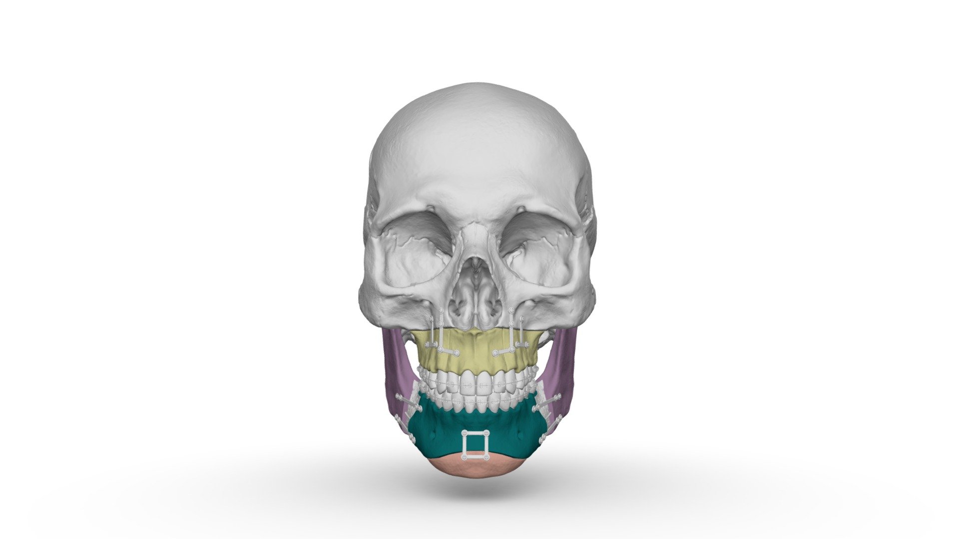 Ортодонтическая операция - 3D model by Dentell [8cc12d5] - Sketchfab