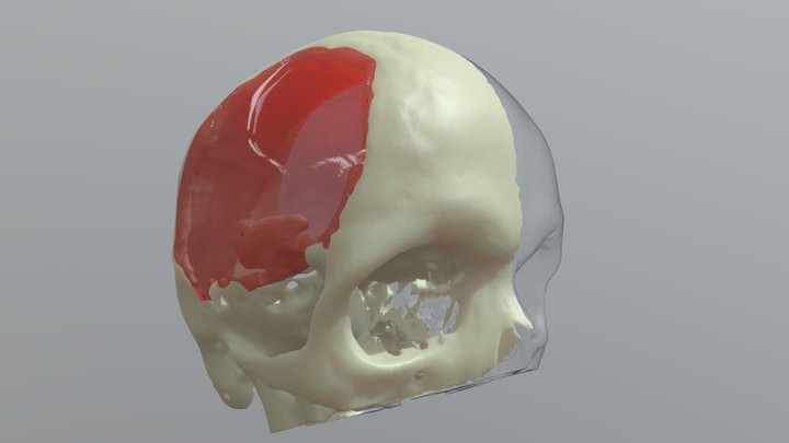 Propuesta_implante_3d 3D Model