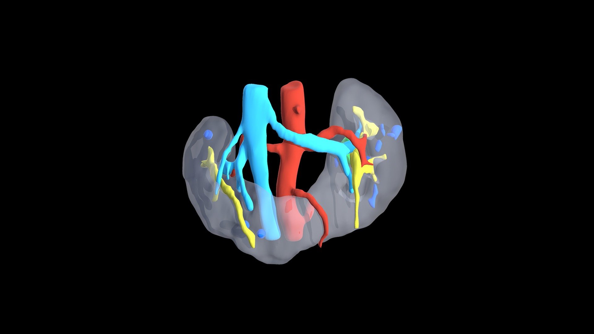 tumor-in-horseshoe-kidney-3d-model-by-cirurgic3d-neorenal-8d2f6d6