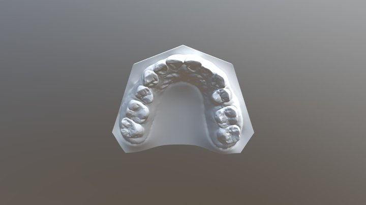 简兰-矫正前-上颚 3D Model