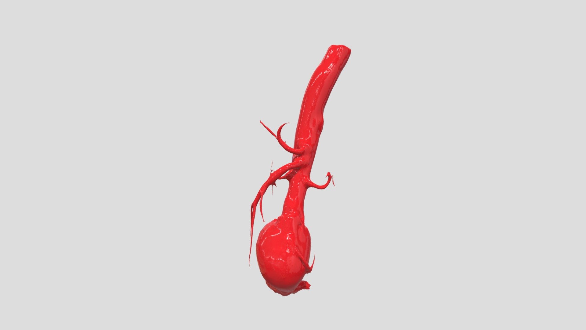Aortic aneurysm - 3D model by msdlt [8e35dcd] - Sketchfab