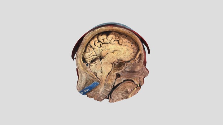 Res Corner Sinus Opticocarotid recess sagital 3D Model