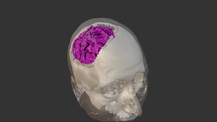Cortical displasia precentral gyrus. 3D Model