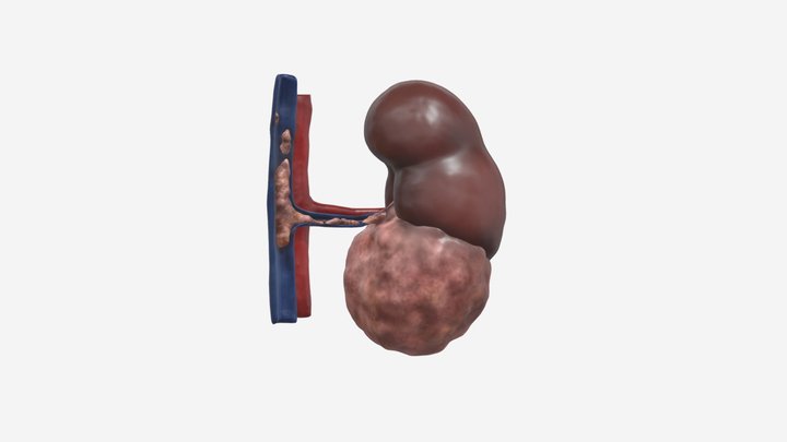 Kidney Cancer - Tumour Thrombosis in IVC 3D Model