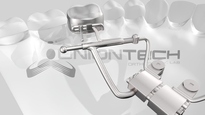 UNIONTECH_Espansore e distalizzatore 3D Model