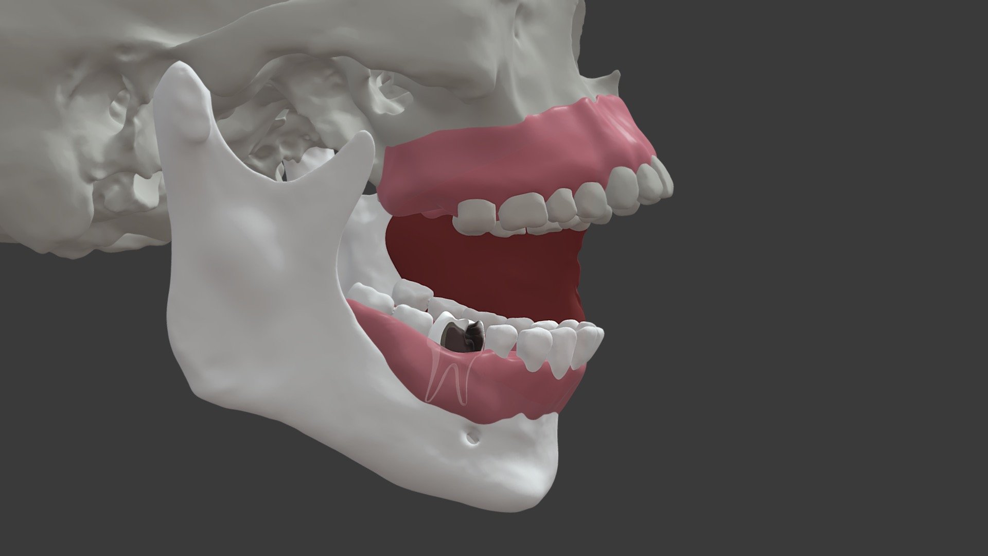 Stage 3- Mandibular Molar Infection Pathway 1 - 3D model by University ...