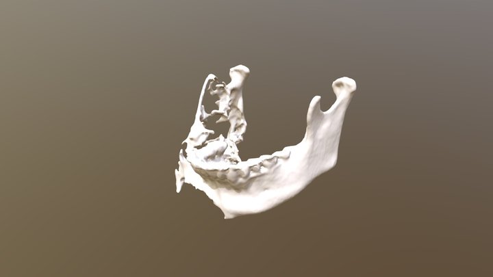 Mandible for Pre-operative planning 3D Model