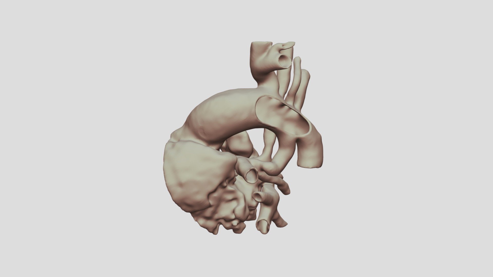 Pulmonary Atresia