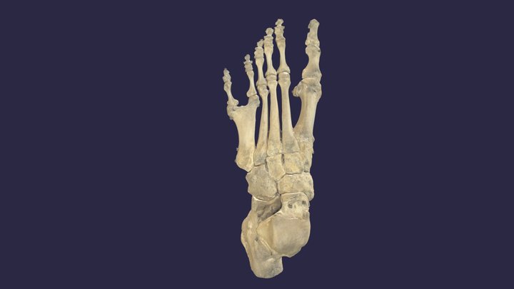 Polydaktylie Fuß links/ Polydactyly  left - copy 3D Model
