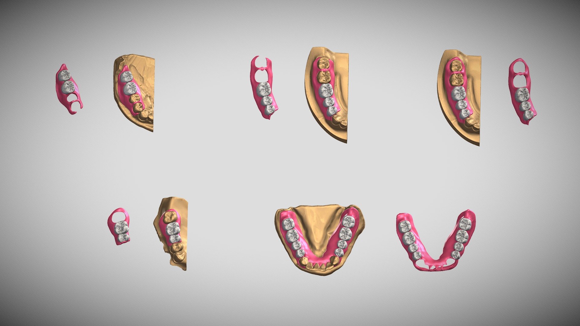 Flexible Denture Clasps Part 2 3D model by Muhammad Nabeel