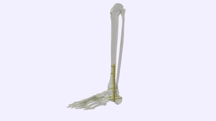 Nail for ankle arthrodesis 3D Model