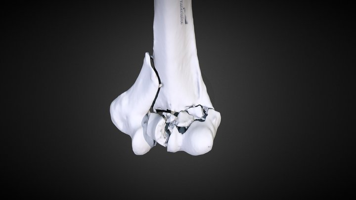 DKOU18 |  distal Humerus fracture | S-170213-L 3D Model