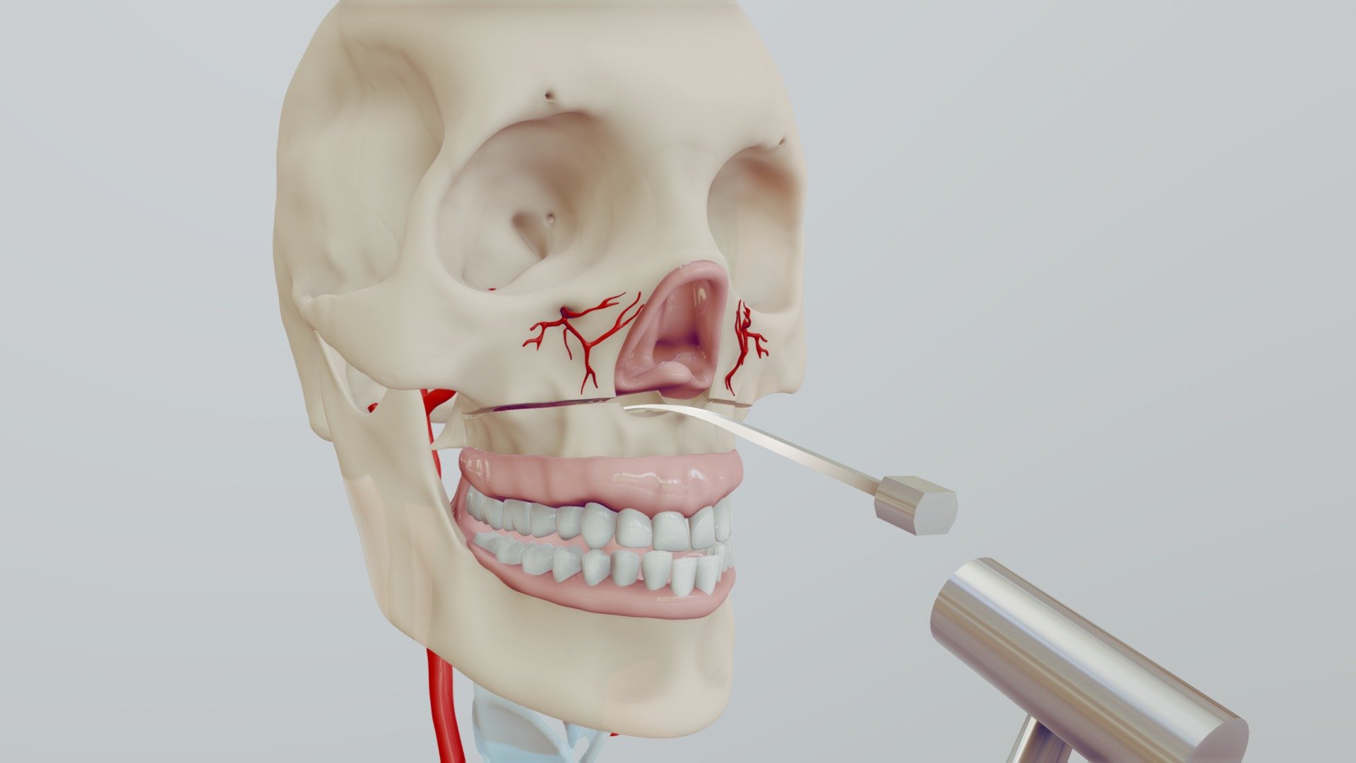 Le Fort 1 Step 3: Septal Osteotomy - 3D model by AUmedart [91c3949 ...