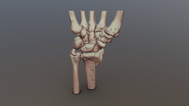 Wrist fracture model for educational purposes 3D Model