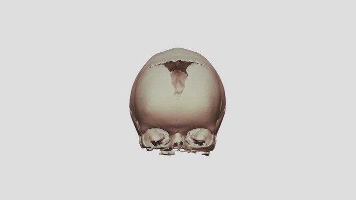 Sagittal Craniosynostosis 3D Model