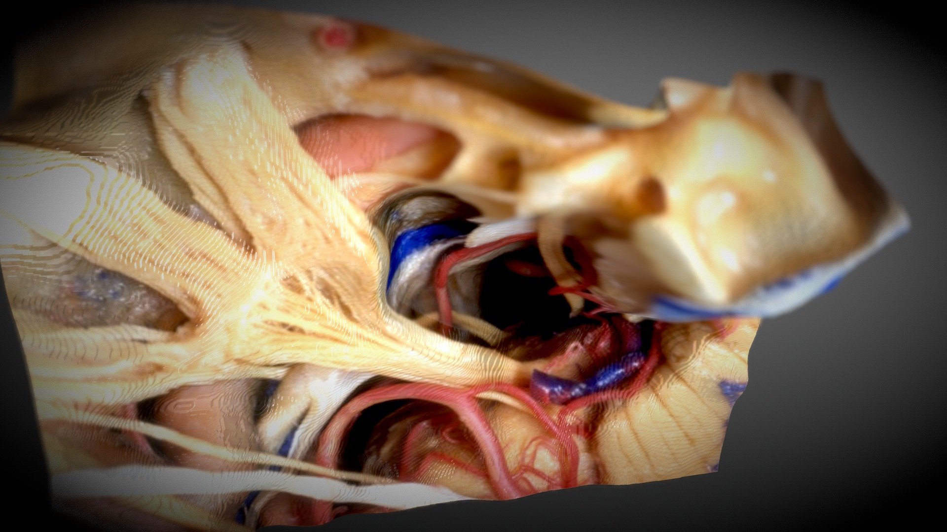 Anterior petrosectomy - Kawase approach