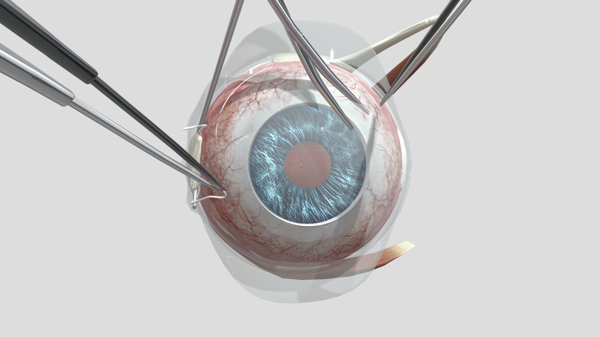 Scleral Buckle - Step 1