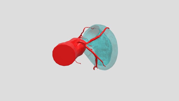 Obstrucive HCM 3D Model