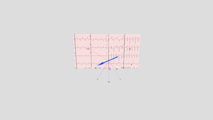 Bidirectional CPVT main axis synced with ECG 3D Model