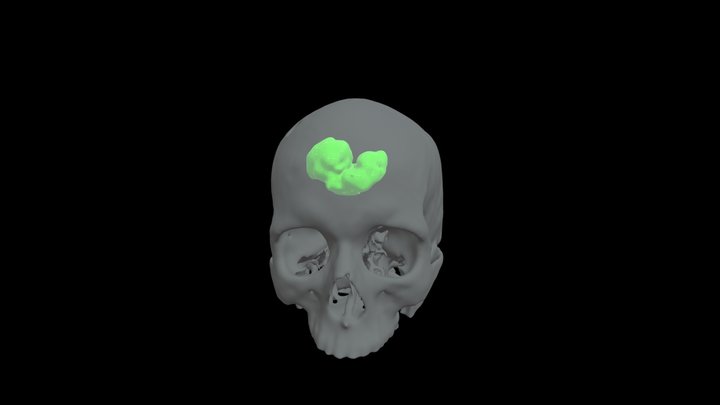 3DSlicer - Skull & Brain Tumour 3D Model
