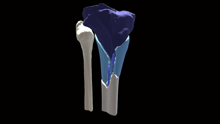 WST Festival 2023 | Proximal Tibia Fractures 3D Model